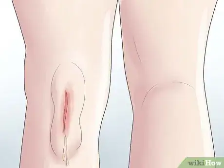 Imagen titulada Know if You Have a Baker's Cyst Step 9