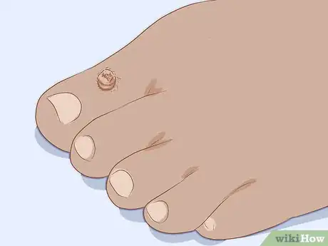 Imagen titulada Identify Warts Step 1