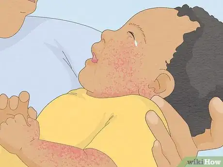 Imagen titulada Treat Baby Heat Rash Step 9