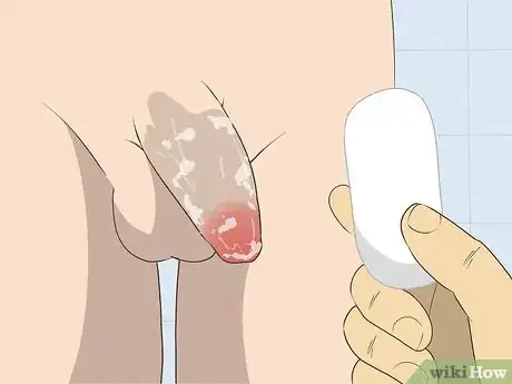Imagen titulada Free a Penis from a Stuck Zipper Step 5