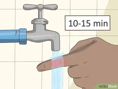 Imagen titulada Treat a Blistering Burn on Your Finger Step 1