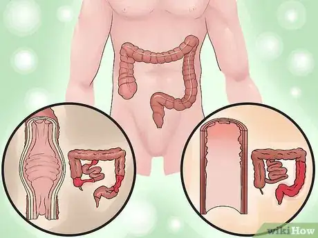 Imagen titulada Distinguish Ulcerative Colitis from Similar Conditions Step 7