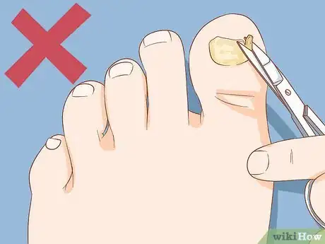Imagen titulada Help a Toenail Grow Back Quickly Step 9