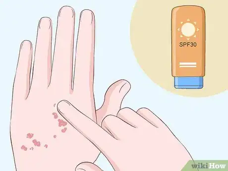 Imagen titulada Heal Scabies Scars Step 6