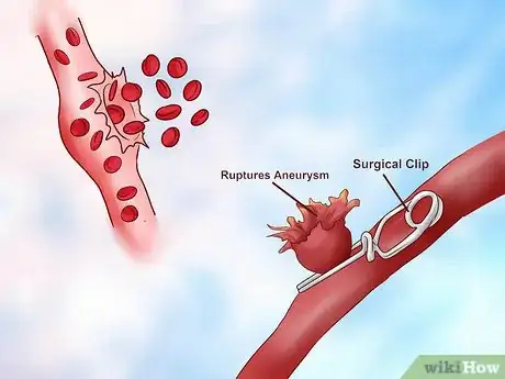 Imagen titulada Recognize the Warning Signs of a Stroke Step 11