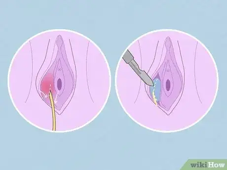 Imagen titulada Treat Vaginal Cysts Step 4