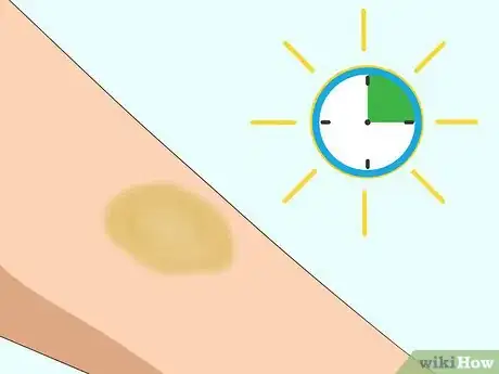 Imagen titulada Make a Bruise Go Away Faster Step 6