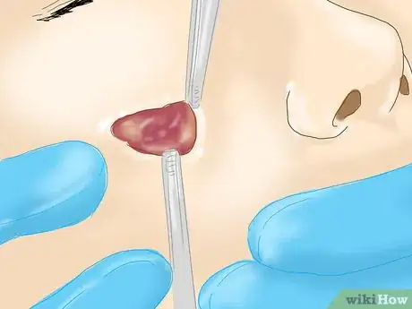 Imagen titulada Check for Skin Cancer Step 8