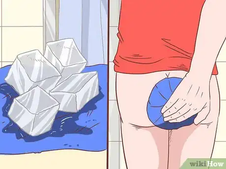Imagen titulada Care for Hemorrhoids Postpartum Step 5