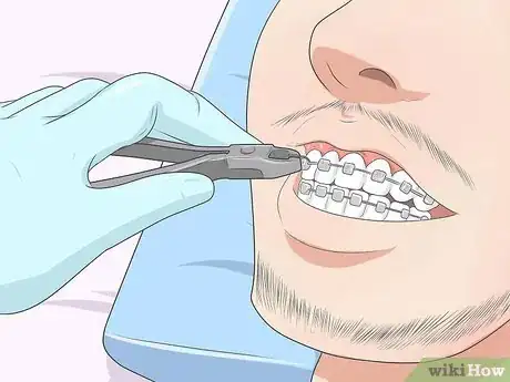 Imagen titulada Make Your Braces Hurt Less Step 12