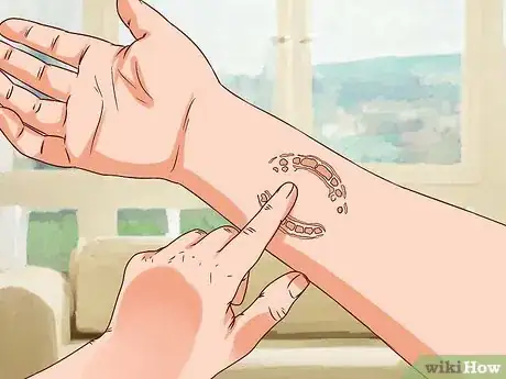 Imagen titulada Treat a Human Bite Step 7