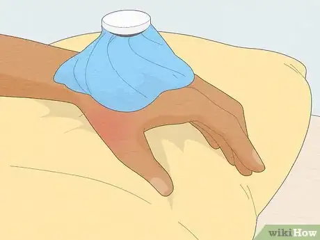 Imagen titulada Wrap a Sprained Thumb Step 12