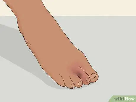 Imagen titulada Buddy Tape an Injured Toe Step 5