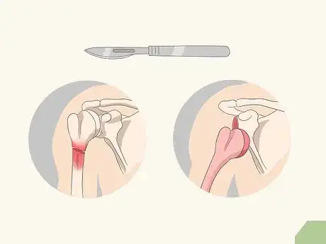Imagen titulada Fix a Dislocated Shoulder Step 9