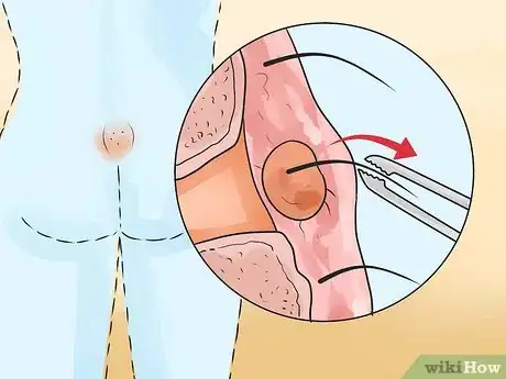 Imagen titulada Get Rid of a Cyst Step 12