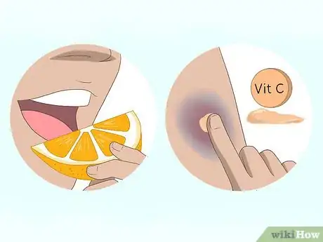 Imagen titulada Make a Bruise Go Away Faster Step 9