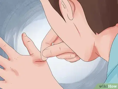 Imagen titulada Check a Wound for Infection Step 8