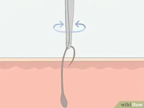 Imagen titulada Get Rid of Ingrown Pubic Hair Step 10