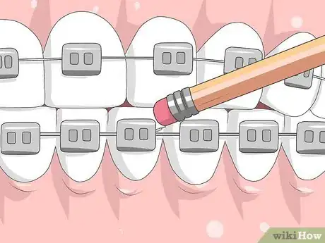 Imagen titulada Make Your Braces Hurt Less Step 11
