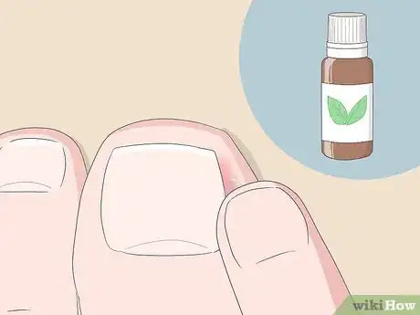 Imagen titulada Relieve Ingrown Toe Nail Pain Step 13