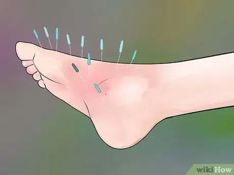 Imagen titulada Reduce Swelling in Feet Step 16