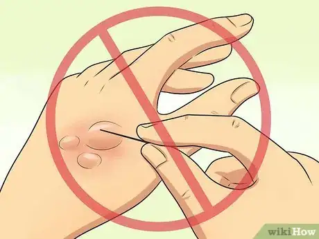 Imagen titulada Treat Minor Burns Step 8
