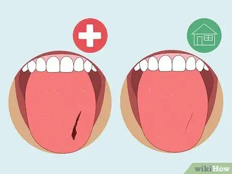 Imagen titulada Heal a Bitten Tongue Step 3