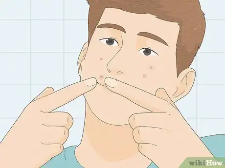 Imagen titulada Pop a Pimple Step 1