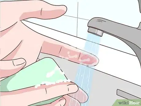 Imagen titulada Treat a Blistering Burn on Your Finger Step 5