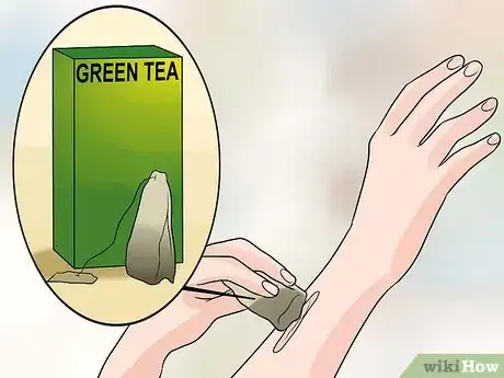 Imagen titulada Remove Keloid Scars at Home Step 8