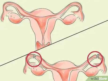 Imagen titulada Prevent Pregnancy Without a Condom Step 6