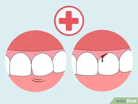 Imagen titulada Heal a Bitten Tongue Step 4