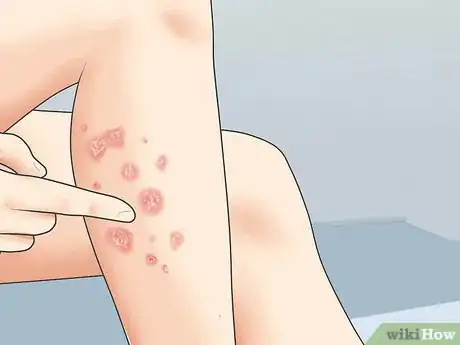 Imagen titulada Diagnose Psoriasis Step 2