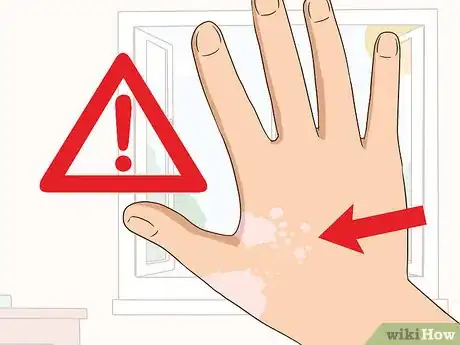 Imagen titulada Treat Tinea Step 11