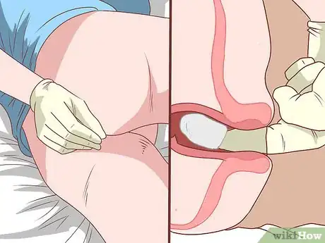 Imagen titulada Insert a Rectal Suppository Step 8