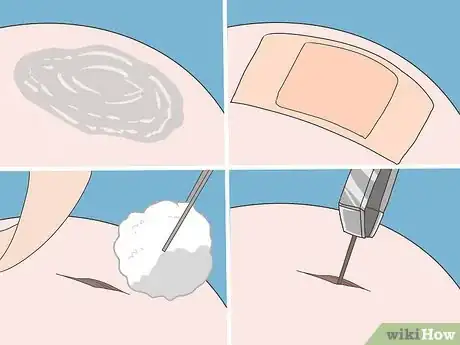 Imagen titulada Remove Splinters from Feet Step 10