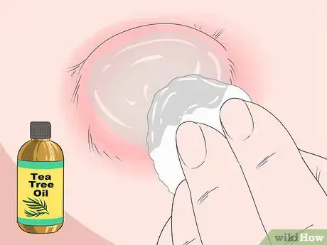Imagen titulada Drain a Cyst Step 7
