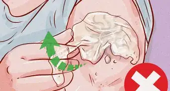 quitar un tatuaje