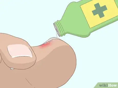 Imagen titulada Relieve Ingrown Toe Nail Pain Step 16