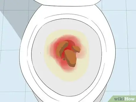 Imagen titulada Recognize Colon Cancer Symptoms Step 1