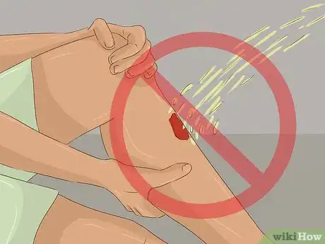 Imagen titulada Treat a Rattlesnake Bite Step 18
