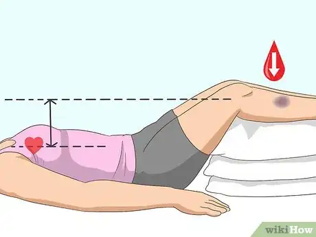 Imagen titulada Make a Bruise Go Away Faster Step 3