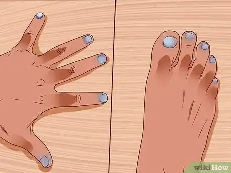 Imagen titulada Diagnose Lupus Step 7