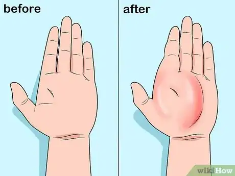 Imagen titulada Prevent Cellulitis Step 7