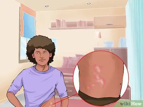Imagen titulada Identify and Treat Ringworm Step 1
