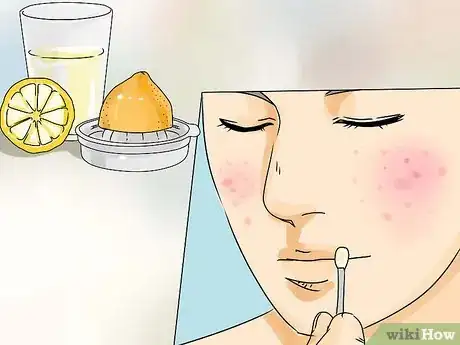 Imagen titulada Get Rid of Pimples on a Tight Budget Step 10