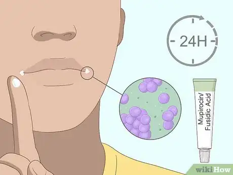 Imagen titulada Cure Angular Cheilitis Step 8