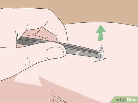 Imagen titulada Remove Glass from a Wound Step 3