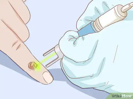Imagen titulada Identify Warts Step 13