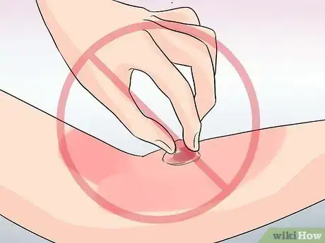 Imagen titulada Treat a Blistered Sunburn Step 2